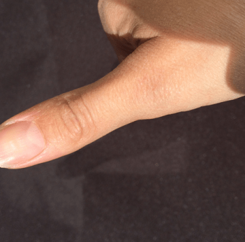 I inlägget ger vi ett exempel på en rollderderbyspelare som har ont i tummen. Därför inkluderar vi ett foto på en tumme.